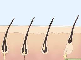 چقدر لیزر موهای زائد بدن اثر بخش نهایی دارد ؟