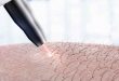 عوارض لیزر مو و درمان سوختگی با لیزر تقلبی و فیک