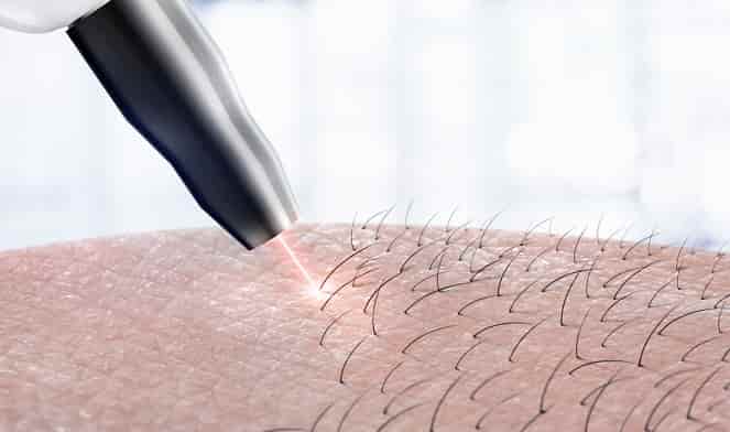 عوارض لیزر مو و درمان سوختگی با لیزر تقلبی و فیک
