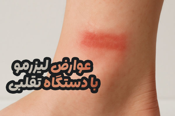 عوارض لیزرمو با دستگاه تقلبی