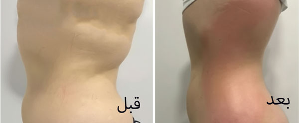 لیپووو کرایو لیپولیز