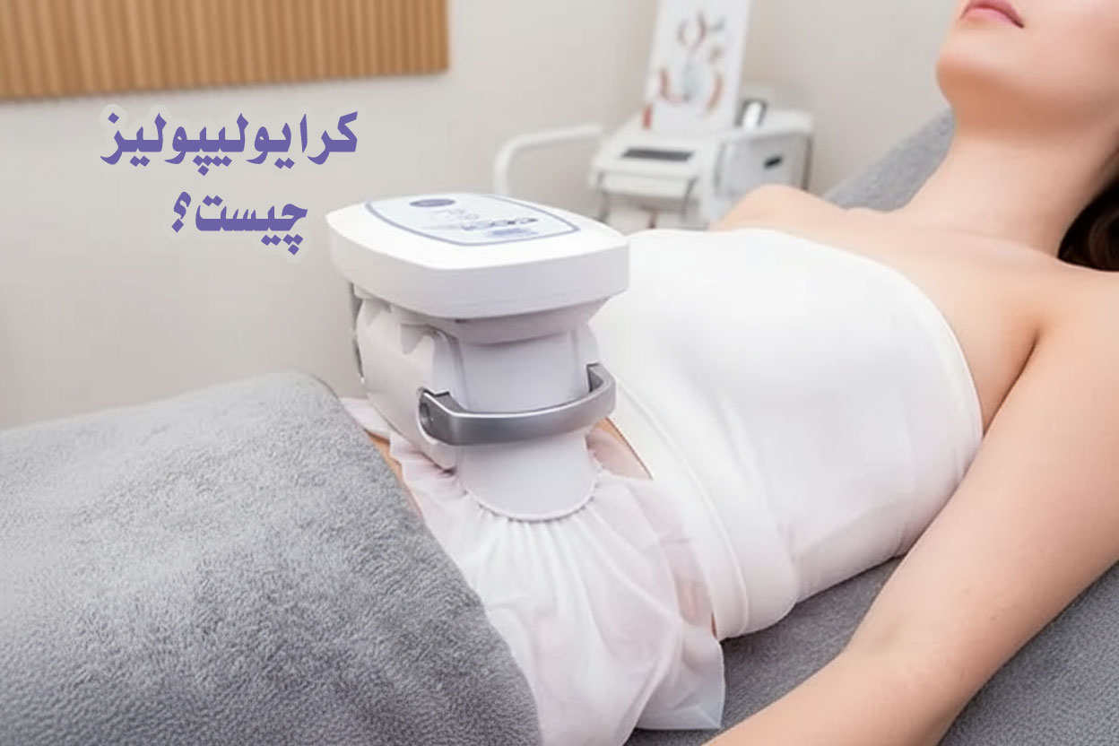 کرایو لیپولیز