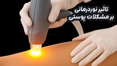 درمان نوری