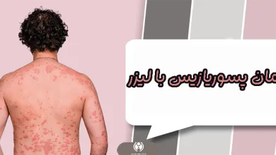 درمان پسوریازیس با لیزر