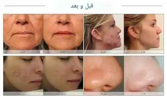 میکرودرم0-optimized میکرودرم