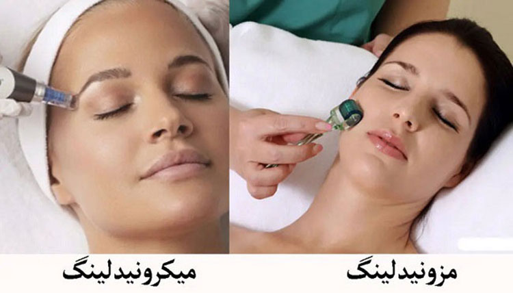 میگرونیدلینگ و مزونیدلینگ