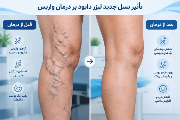بهترین-دستگاه-لیزر-واریس-پا بهترین دستگاه لیزر واریس پا